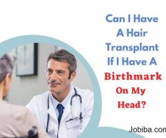 Can I Have A Hair Transplant If I Have A Birthmark On My Head?