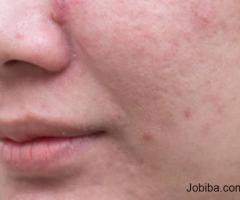 Best Acne Treatment in Hyderabad: Magna Centre