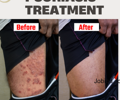 Scalp psoriasis homeopathy treatment without any side effects
