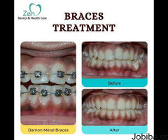 Best Dental Braces Treatment in Bangalore