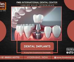 A Long-Term Investment In Oral Health : Dental Implants At FMS Dental