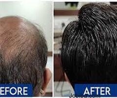 Transform Your Look with Expert Hair Transplant Services in Nashik