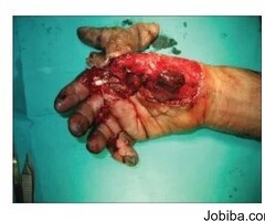 Expert Care for Hand Trauma: Dr. Rahul Dalal in Pune