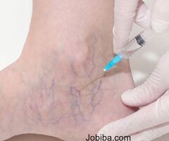 Sclerotherapy Treatment For Varicose And Spider veins In Jersey City | Advanced Medical Group