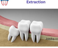 Impacted Wisdom Tooth Extraction | Wisdom Tooth Surgery