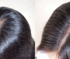 Hair Dandruff Treatment in Chennai