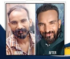 Best and Advance Hair Transplant Specialist in Chandigarh